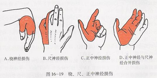 桡神经损伤容易与哪些疾病混淆