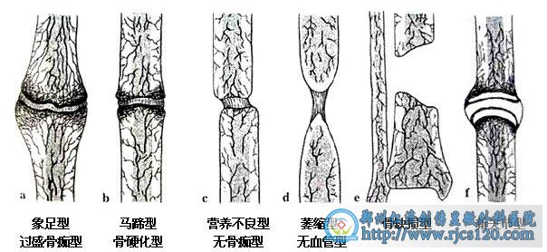 河南骨不连医院哪家最好