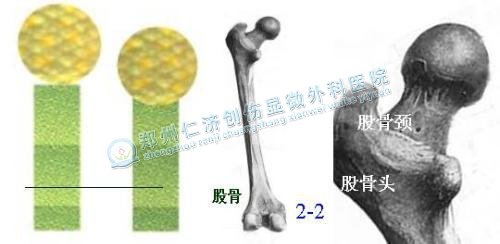 股骨头坏死最新疗法的优势