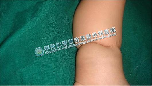 你知道如何预防羊膜带综合征吗