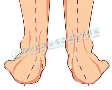 足外翻危害