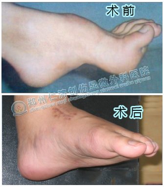 高弓足有什么表现症状?