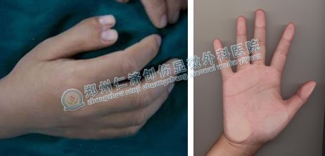 成人多指(六指)切除术