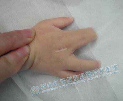 宝宝手指粘连,让父母不治所错!