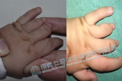 治好束带综合征 <wbr>妈妈不用再担心