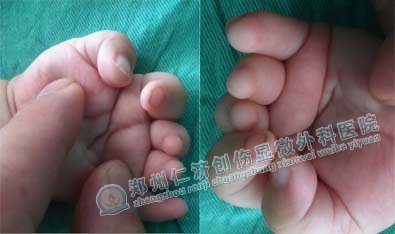 治好束带综合征 <wbr>妈妈不用再担心