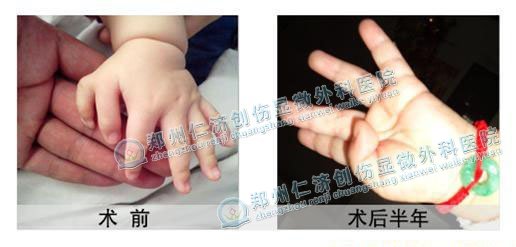 手术         一,要掌握最佳的治疗时间    对于多指(六指)的治疗最佳