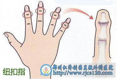 纽扣指畸形
