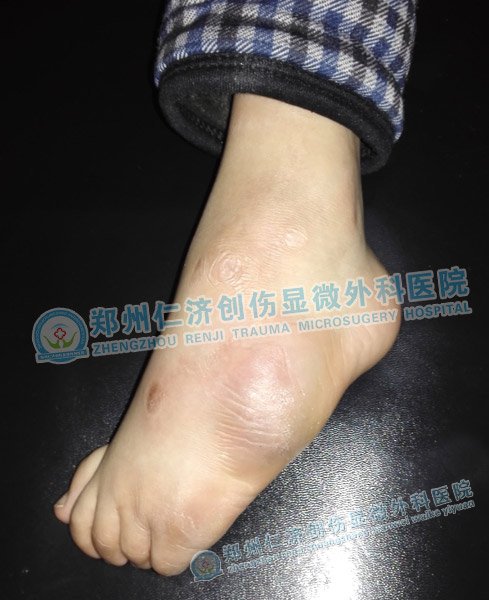 脚背外侧已经磨出老茧,鼓起大包