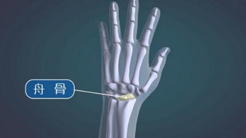 腕舟骨坏死病因