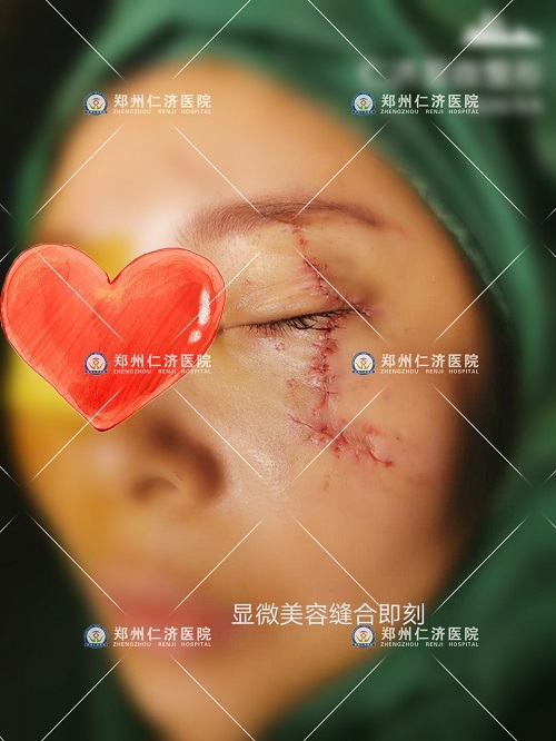 显微美容缝合技术有多强大?一组图告诉你