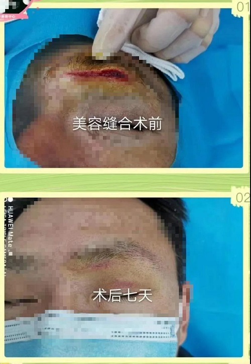 乘风破浪的美容缝合技术,让你和疤痕说"再见"